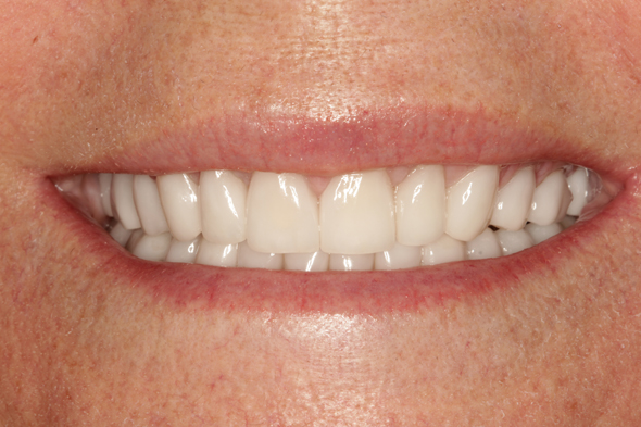 1 After Sculpting w New restoratins