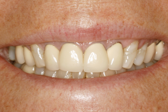 1 Before Sculpting w Restorations