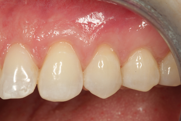 1 Gum Graft After