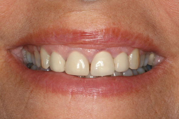 2 Before Sculpting w New Restorations