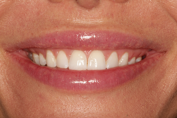 3 After Sculpting Natural Teeth