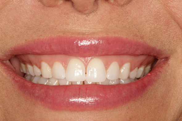 3 Before Sculpting Natural Teeth