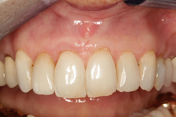 3 Gum Graft After