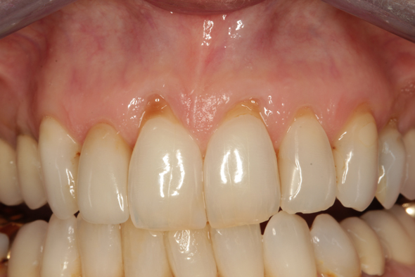 3 Gum Graft Before