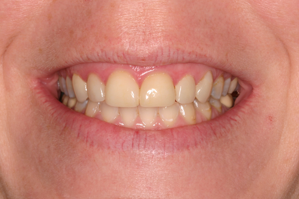 5 Before Sculpting New Restorations